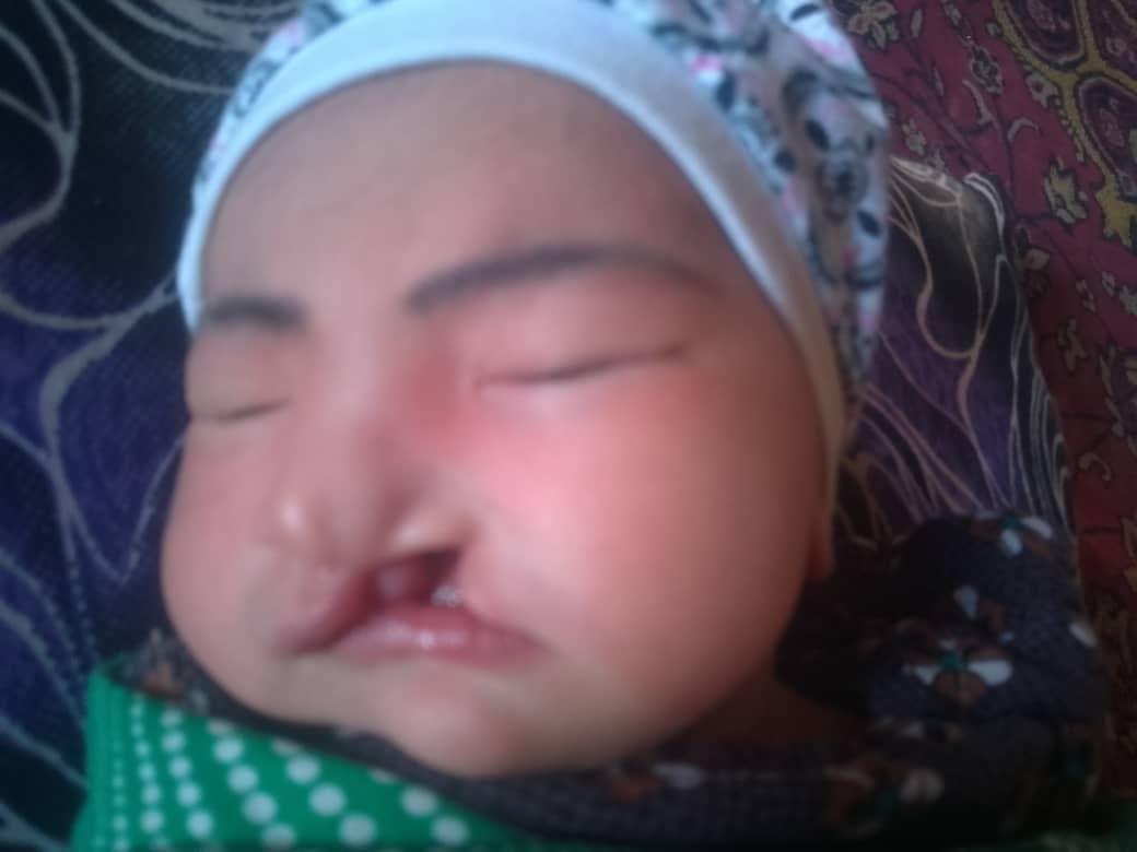 Surgery of an infant